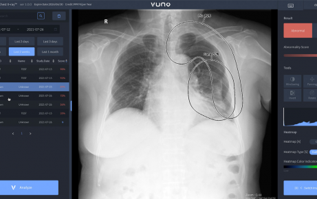 Phần mềm A.I hỗ trợ tầm soát nốt phổi